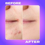 Dalmatian Hydrocolloid Acne Pimple Patches for Zits and Blemishes - Cutie Spot Stickers, Vegan and Cruelty-Free (32 Count). - Image 6